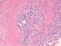 Lymphomatoid granulomatosis-HE