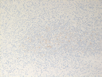 Splenic marginal zone lymphoma-CD20