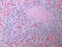 Splenic marginal zone lymphoma-HE