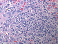 Splenic marginal zone lymphoma-HE