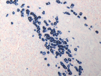 Splenic marginal zone lymphoma-Kappa ISH