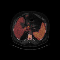 Mantle cell lymphoma-PET