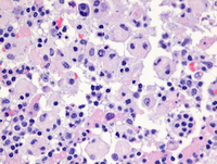 Rosai-Dorfman disease-HE