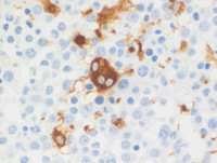 Myeloid Neoplasm-GATA2-proband