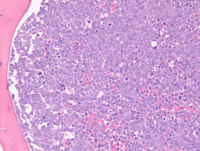 Myeloid Neoplasm-GATA2-HE