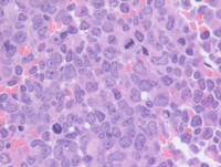 Myeloid Neoplasm-GATA2-HE