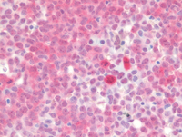 Myeloid Neoplasm-GATA2-NPM1