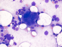 Myeloid Neoplasm-GATA2 Aspirate