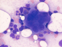 Myeloid Neoplasm-GATA2 Aspirate
