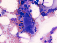 Myeloid Neoplasm-GATA2 Aspirate