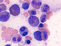Myeloid Neoplasm-GATA2 Aspirate