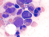 Myeloid Neoplasm-GATA2 Aspirate