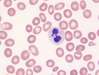 Myeloid Neoplasm-GATA2-Blood