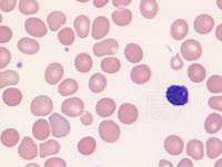Myeloid Neoplasm-GATA2-Blood