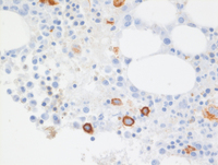 Myeloid Neoplasm-GATA2-CD34