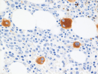 Myeloid Neoplasm-GATA2