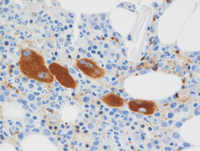 Myeloid Neoplasm-GATA2-CD61