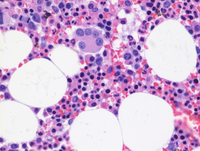 Myeloid Neoplasm-GATA2-Biopsy HE