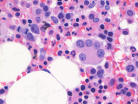 Myeloid Neoplasm-GATA2-Biopsy HE