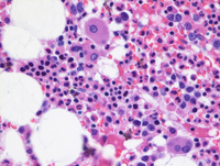 Myeloid Neoplasm-GATA2-Biopsy HE