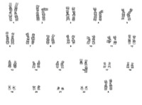 Karyotype-sister t(1;16)
