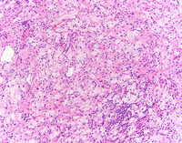 Erdheim-Chester Disease