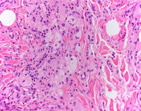 Erdheim-Chester Disease