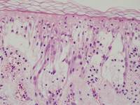 Hydroa Vacciniforme-like Lymphoproliferative Disorder-H&E