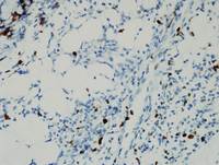 Current-Classification-WHO-2016-of-EBv-Tcell-and-NKcell-Proliferations