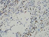 Current-WHO-2016-Classification-of-EBV-Tcell-and-NKcell-Proliferations