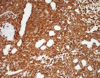 NK-cell enteropathy-CD56