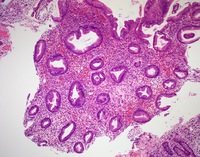 NK-cell enteropathy-HE