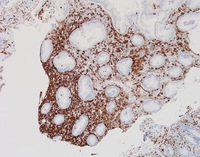 NK-cell enteropathy