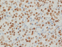 ALCL-GATA3