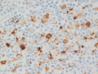 ALCL-Granzyme B