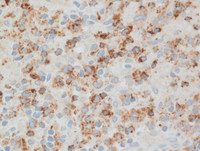 ALCL-TIA1