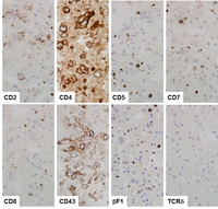 BIA-ALCL