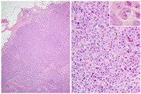 ALCL-TP63R