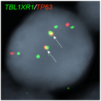 ALCL-TP63R