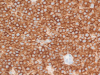 Myeloma with Cyclin D1