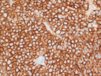 Myeloma with Cyclin D1