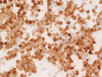Myeloma with Cyclin D1