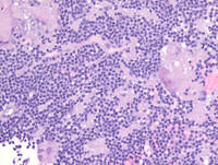 Myeloma with Cyclin D1