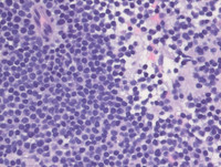 Myeloma with Cyclin D1