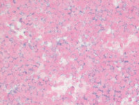 Myeloma with Cyclin D1