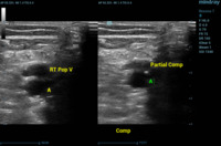 Thrombus in vein
