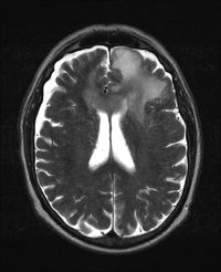 PCNSL-MRI