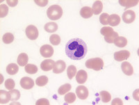MDS-RS-MLD- Blood