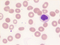 MDS-RS-MLD- Blood
