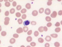 MDS-RS-MLD- Blood